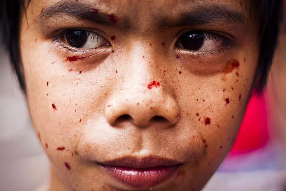 Young boy with blood spotted face