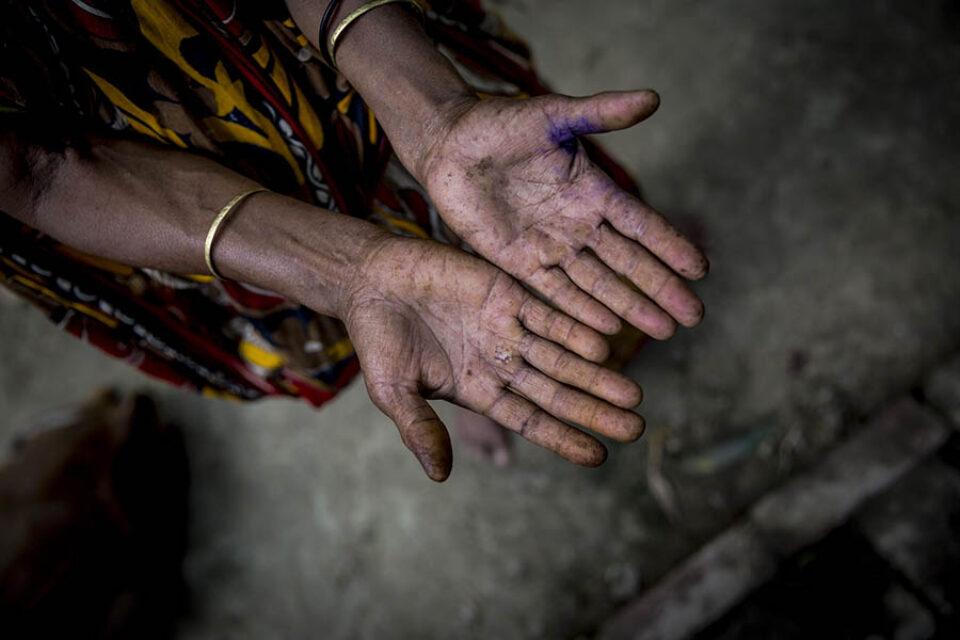 Hands with arsenicosis markings