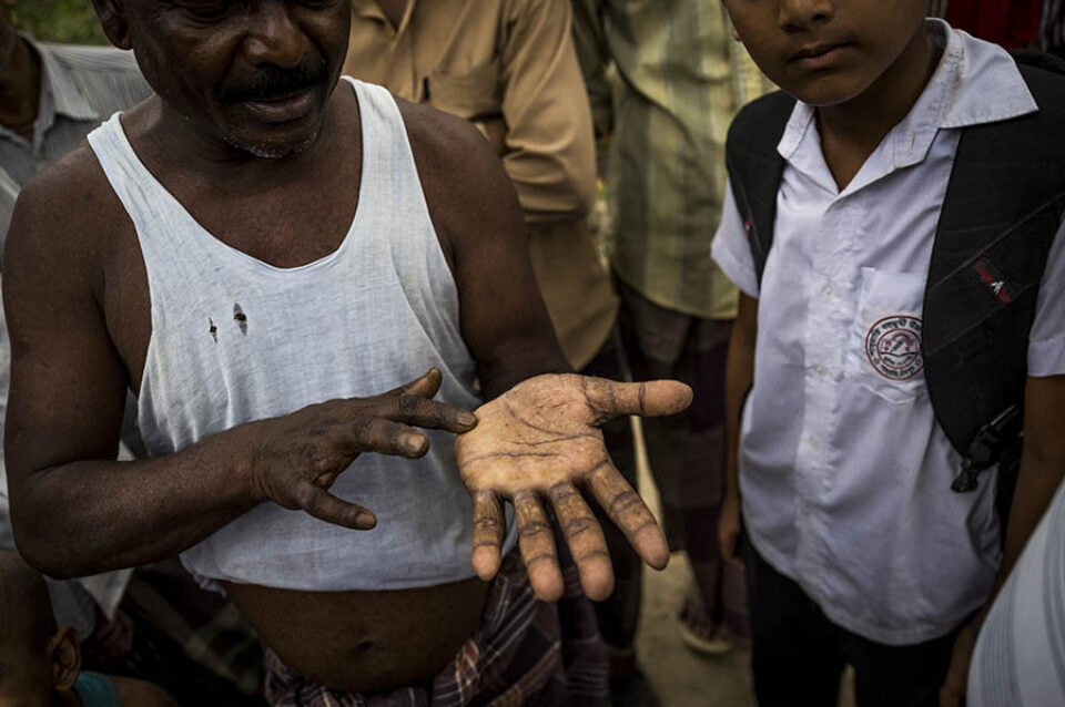 Man showing arsenicosis on hand